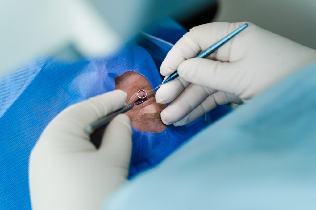 Opération de la myopie à Chambéry