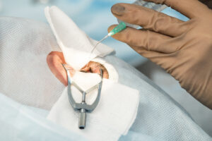 Opération des yeux à Mâcon : le Dr Yoann Soldermann propose un accompagnement expert en chirurgie laser pour corriger votre vision.